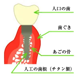 インプラントの利点