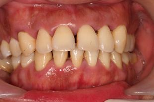 歯石が沈着している中程度に進行している歯周病罹患者の口腔内
